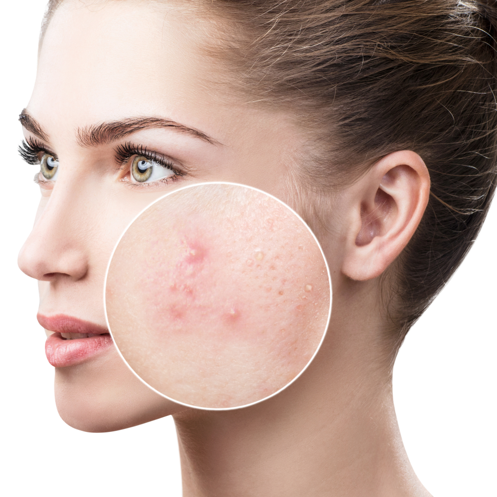traiter acné adulte naturellement
